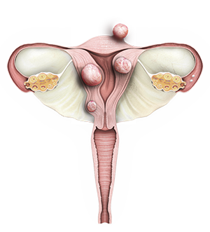 Fibroid Removal/Myomectomy