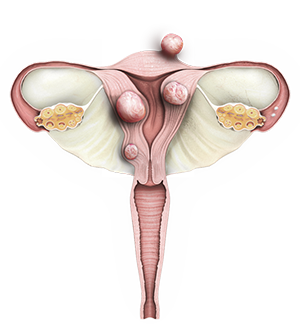 Fibroids