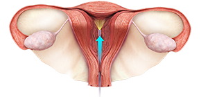 Hysteroscopy