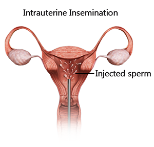 Intra-uterine Insemination
