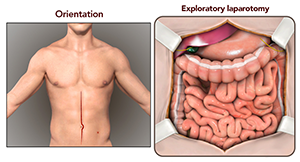 Laparoscopy