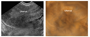 Pelvic Ultrasound